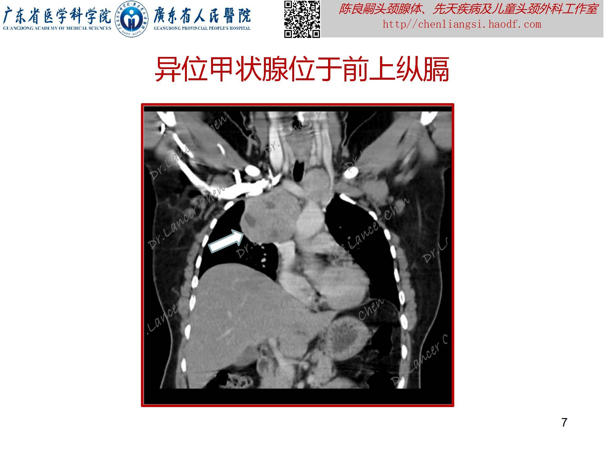 20230723：医学科普——貌似甲状舌管囊肿的罕见先天疾患——异位甲状腺_07.jpg