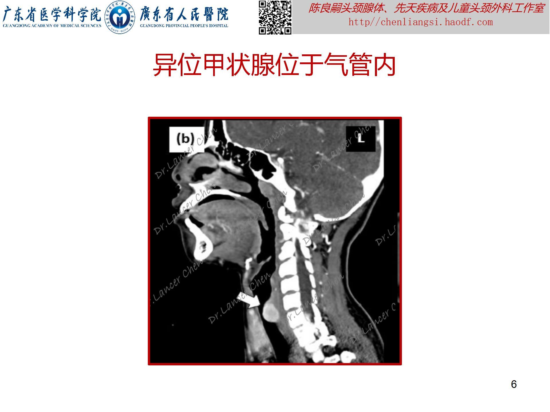 20230723：医学科普——貌似甲状舌管囊肿的罕见先天疾患——异位甲状腺_06.jpg