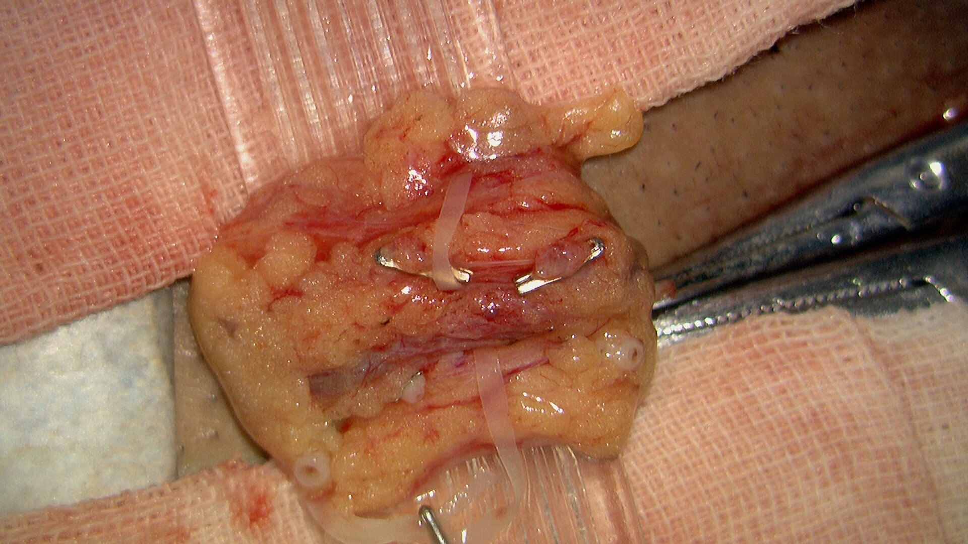 精索静脉曲张结扎术