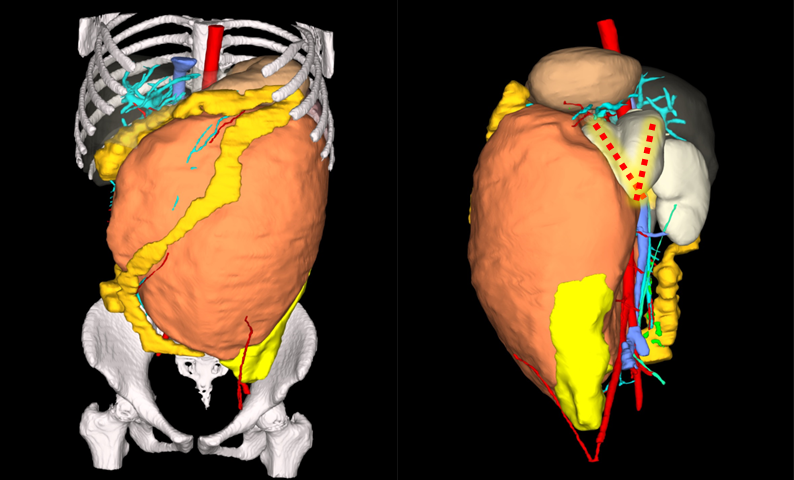 虚拟图显示左侧V型折叠肾脏内的巨大肿瘤.png