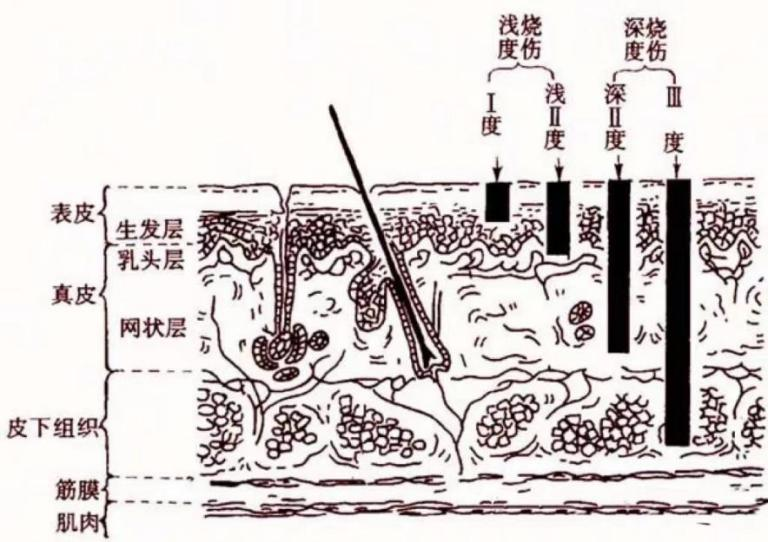 烧烫伤后一定会留疤吗？_烧伤_烧伤介绍 - 好大夫在线