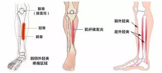 胫骨骨膜炎照片图片