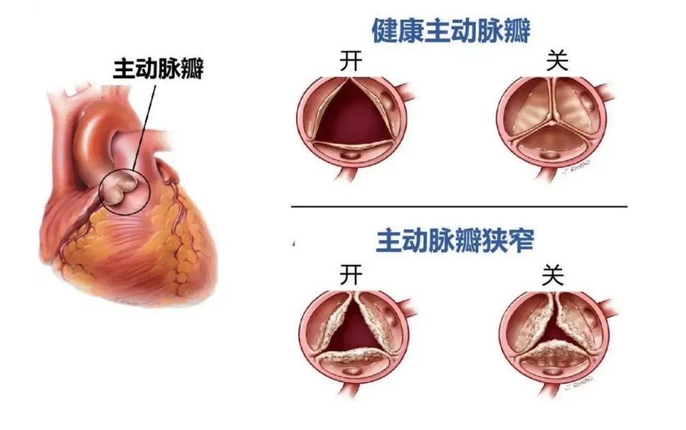 主动脉瓣狭窄是指主动脉瓣发生缩窄或结构异常的状态。