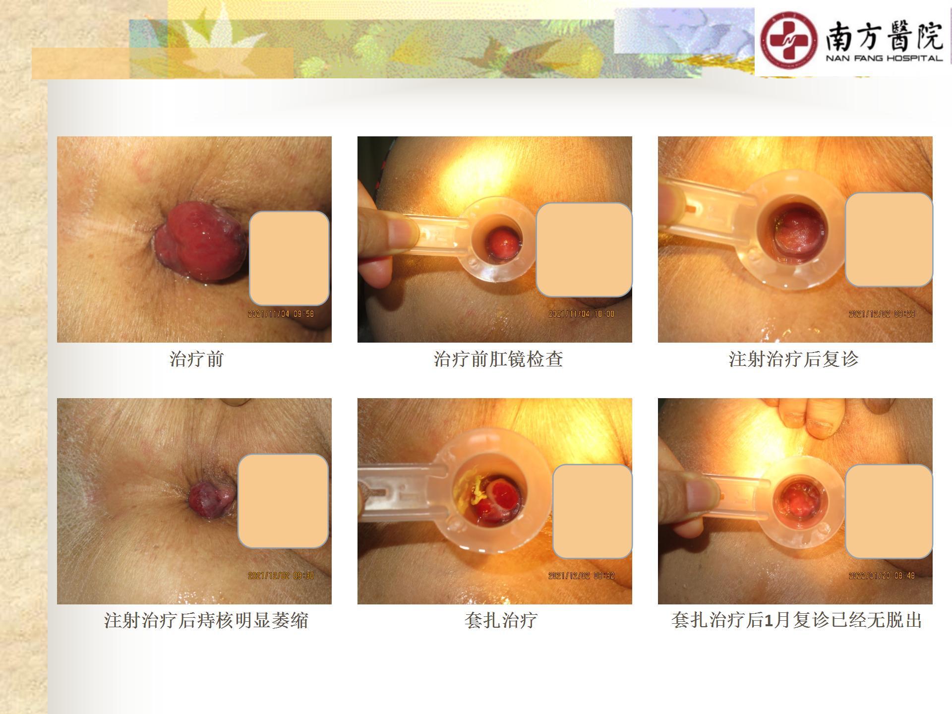 痔的精准化规范化微创化治疗之痔脱出1_15.jpg