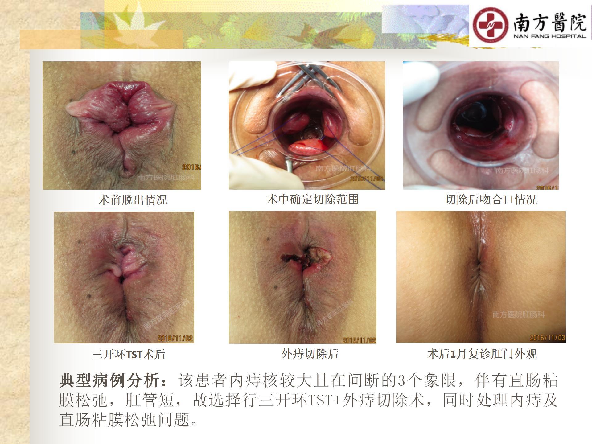 痔的精准化规范化微创化治疗之痔脱出1_22.jpg