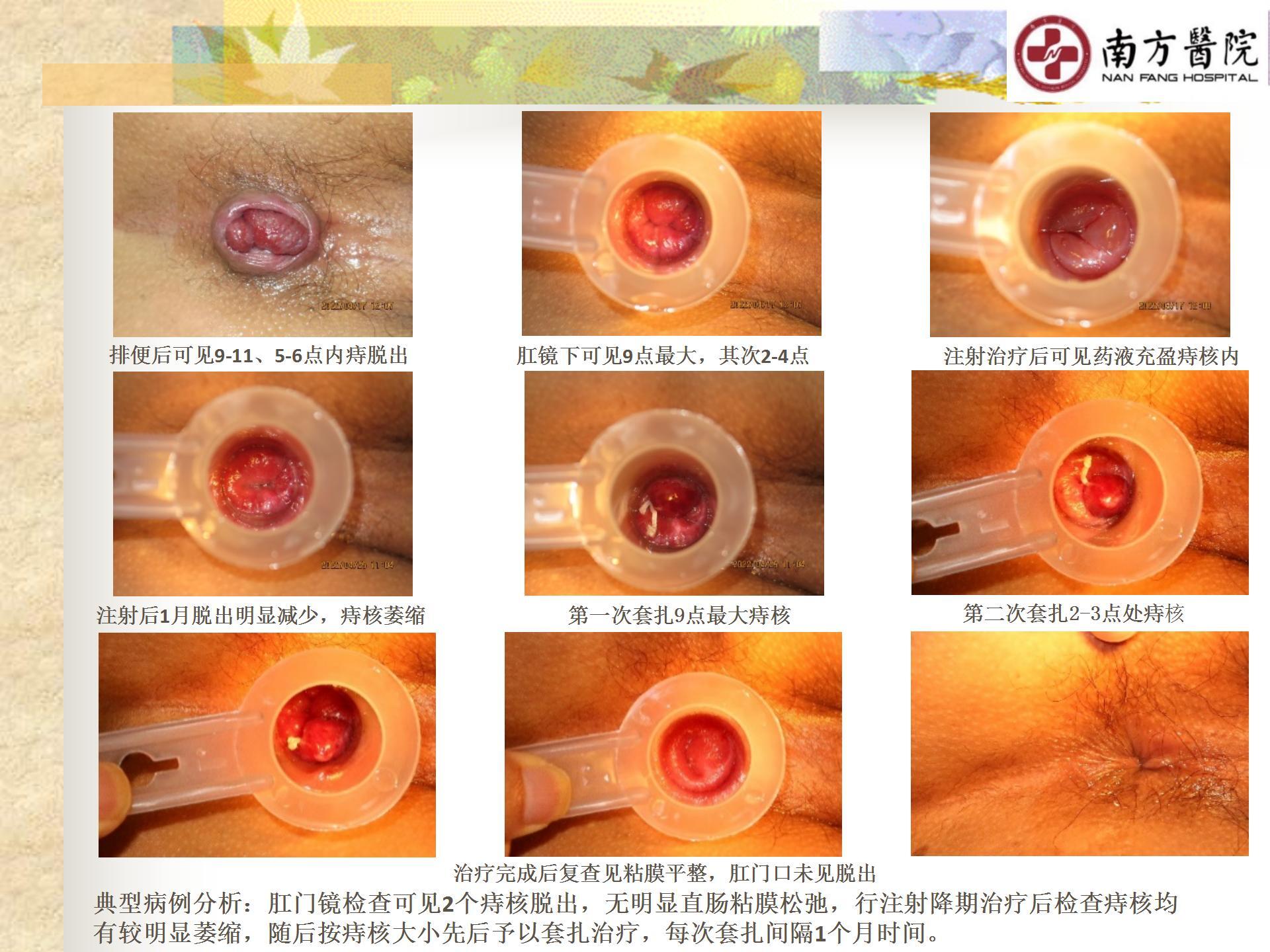 痔的精准化规范化微创化治疗之痔脱出1_11.jpg