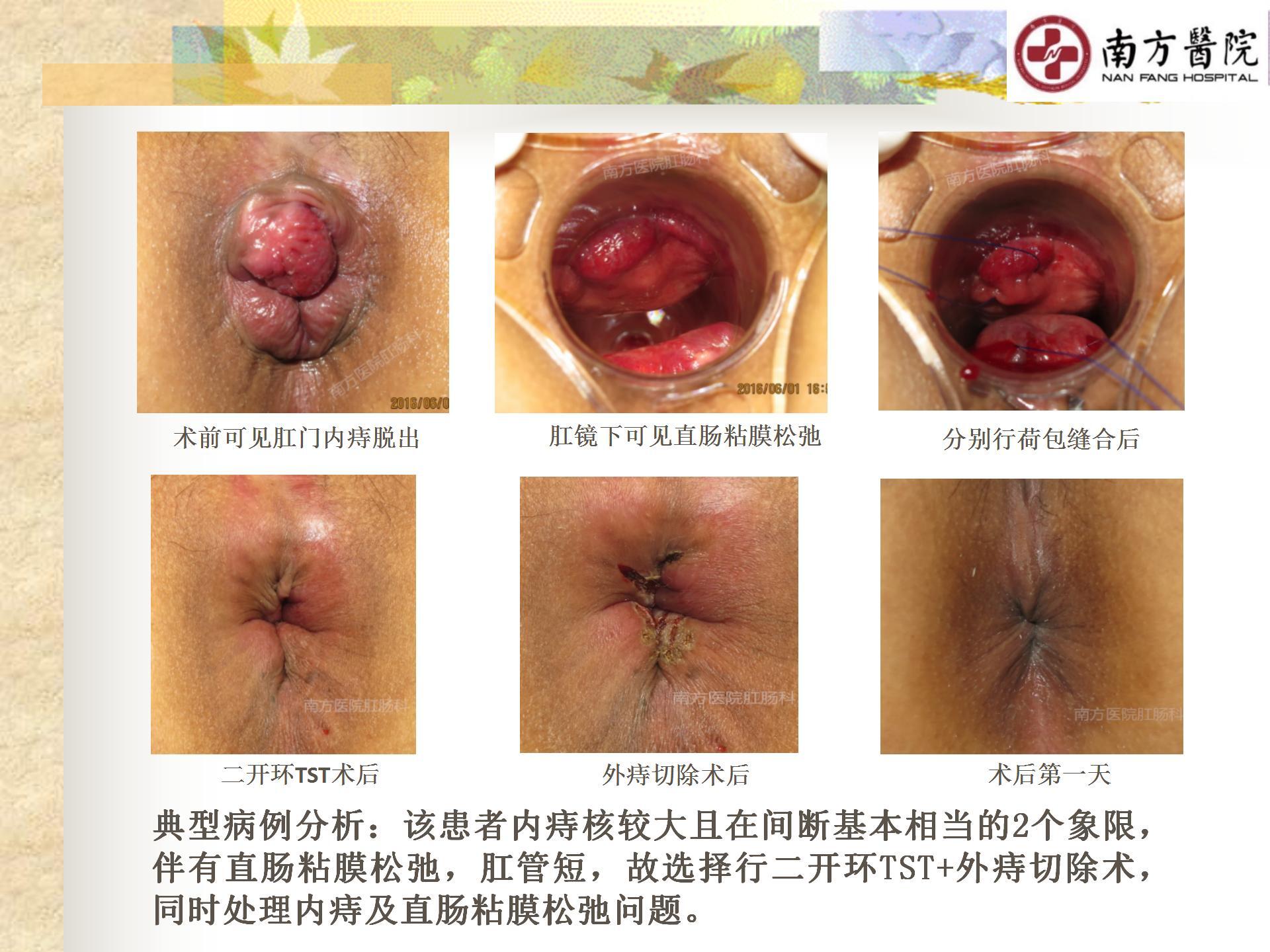 痔的精准化规范化微创化治疗之痔脱出1_20.jpg