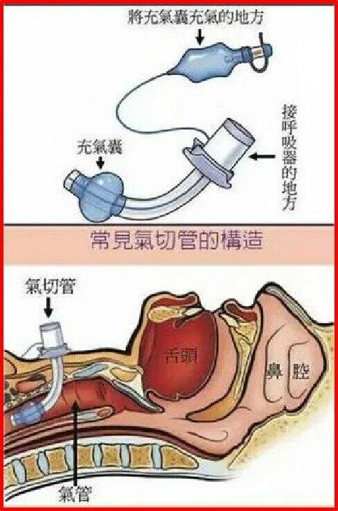 气管切开示意图(1).jpg