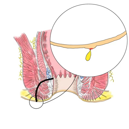 肛瘘 隐藏在肛门的秘密通道