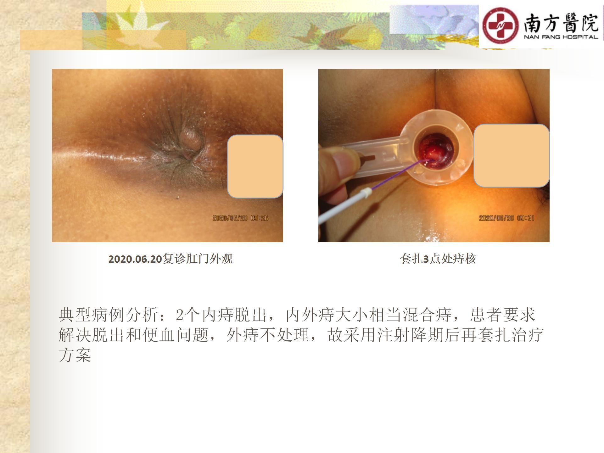 痔的精准化规范化微创化治疗之痔脱出2_11.jpg