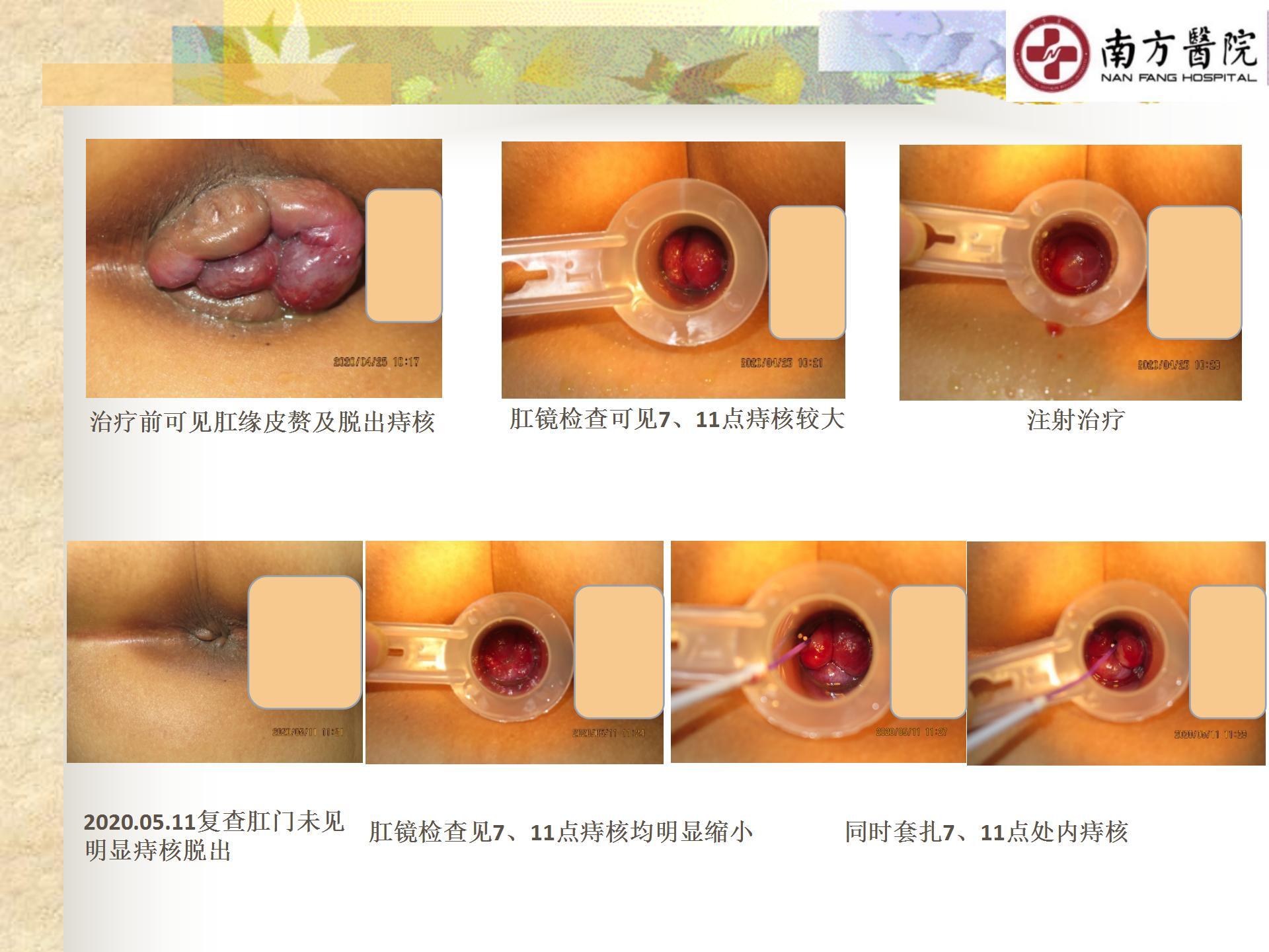 痔的精准化规范化微创化治疗之痔脱出2_10.jpg