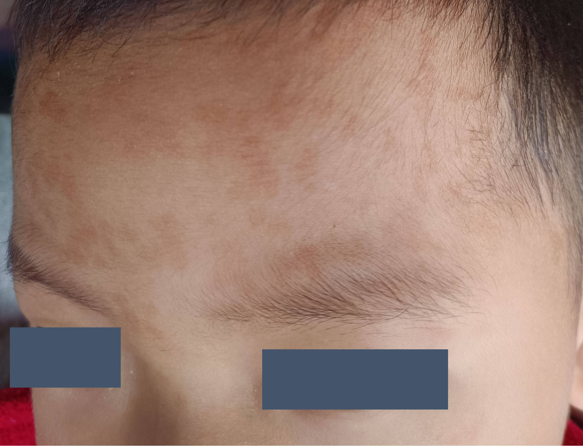 婴儿额头的小褐斑一哭闹就变红,是什么?