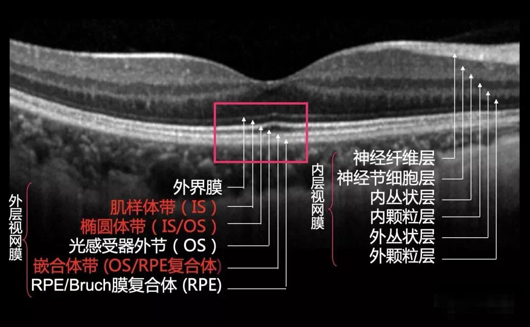 星状玻璃体变性超声图片