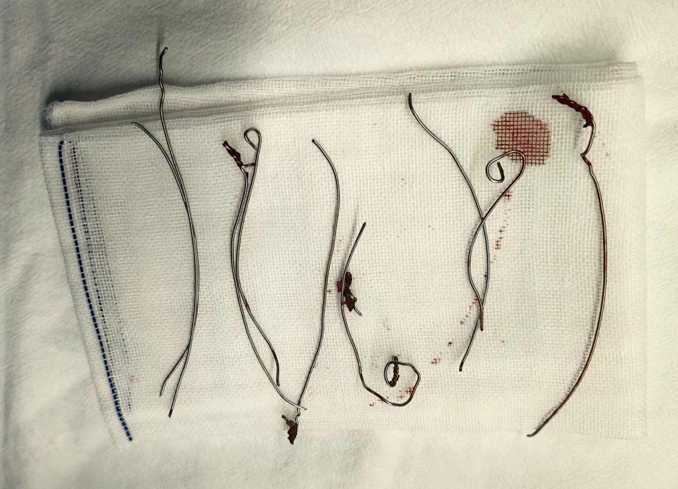 2 手术取出之钢丝.jpg