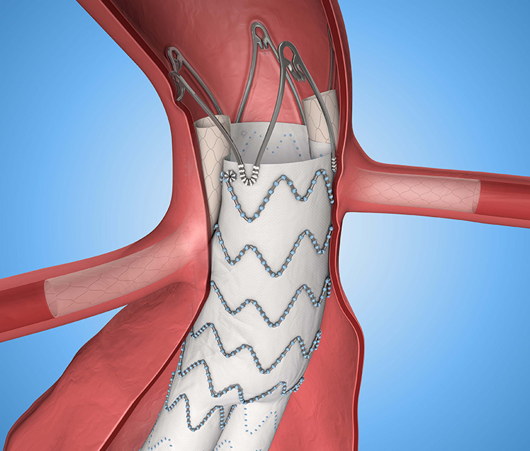 主动脉覆膜支架图片图片