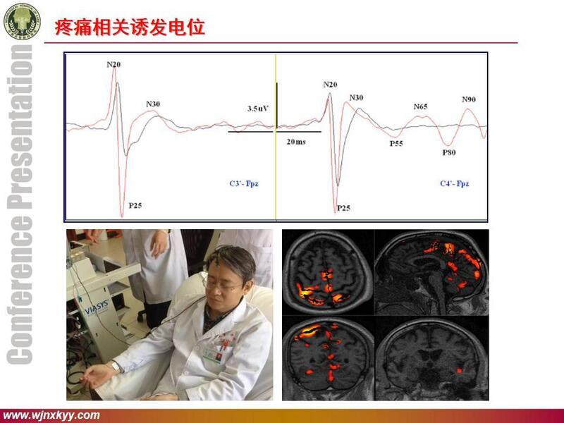 短潜伏期诱发电位.jpg