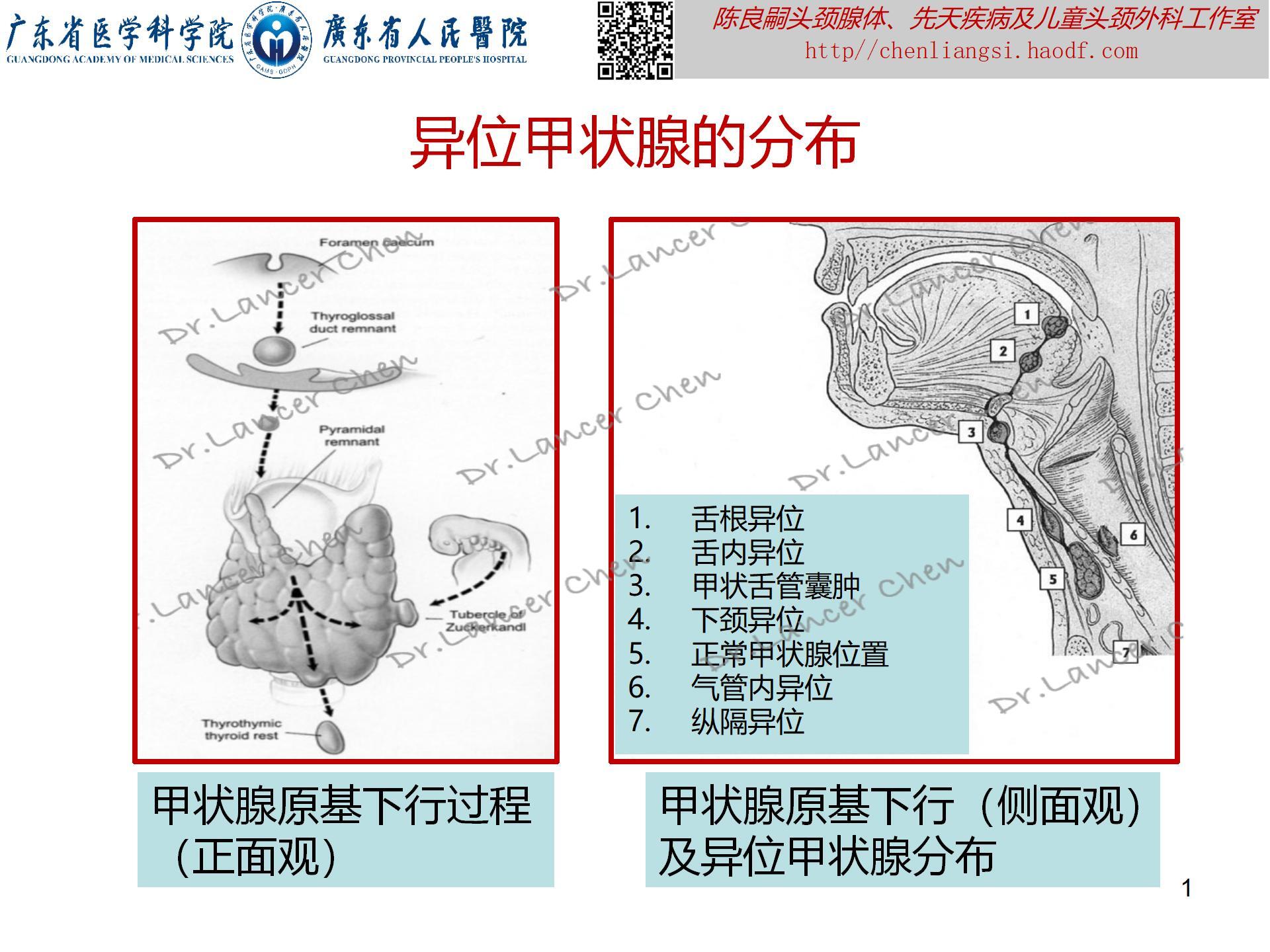 20230723：医学科普——貌似甲状舌管囊肿的罕见先天疾患——异位甲状腺_01.jpg