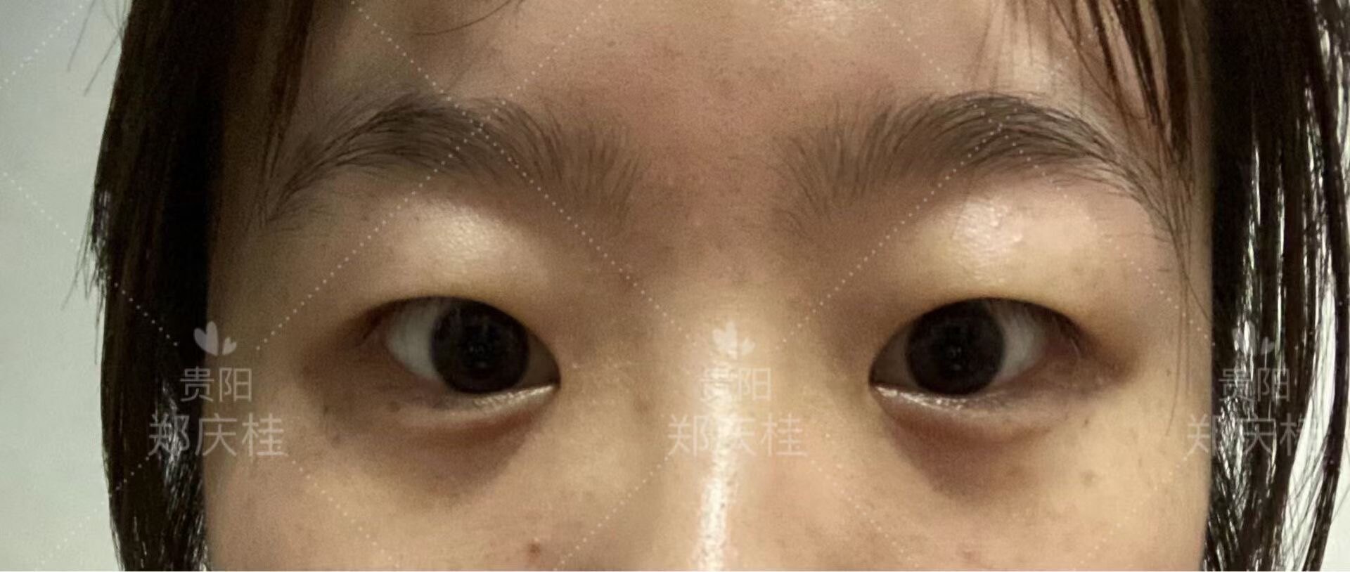 韩国开扇型双眼皮手术经历超详细分享（韩式五点+提肌+开眼角） - 知乎