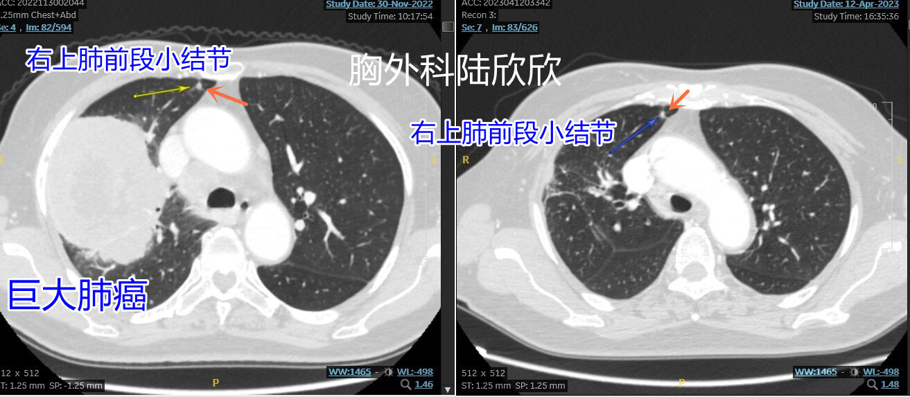 右前段小结节治疗后不变2 - 副本.jpg