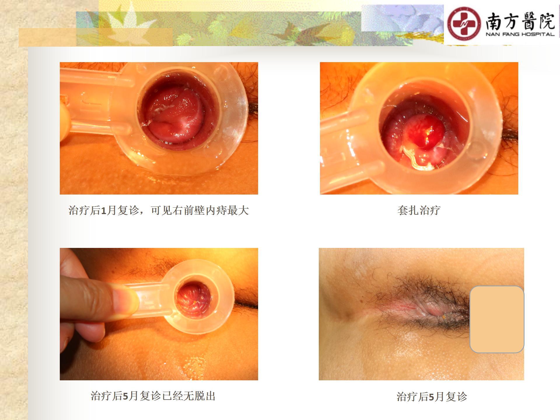 痔的精准化规范化微创化治疗之痔脱出3_16.jpg