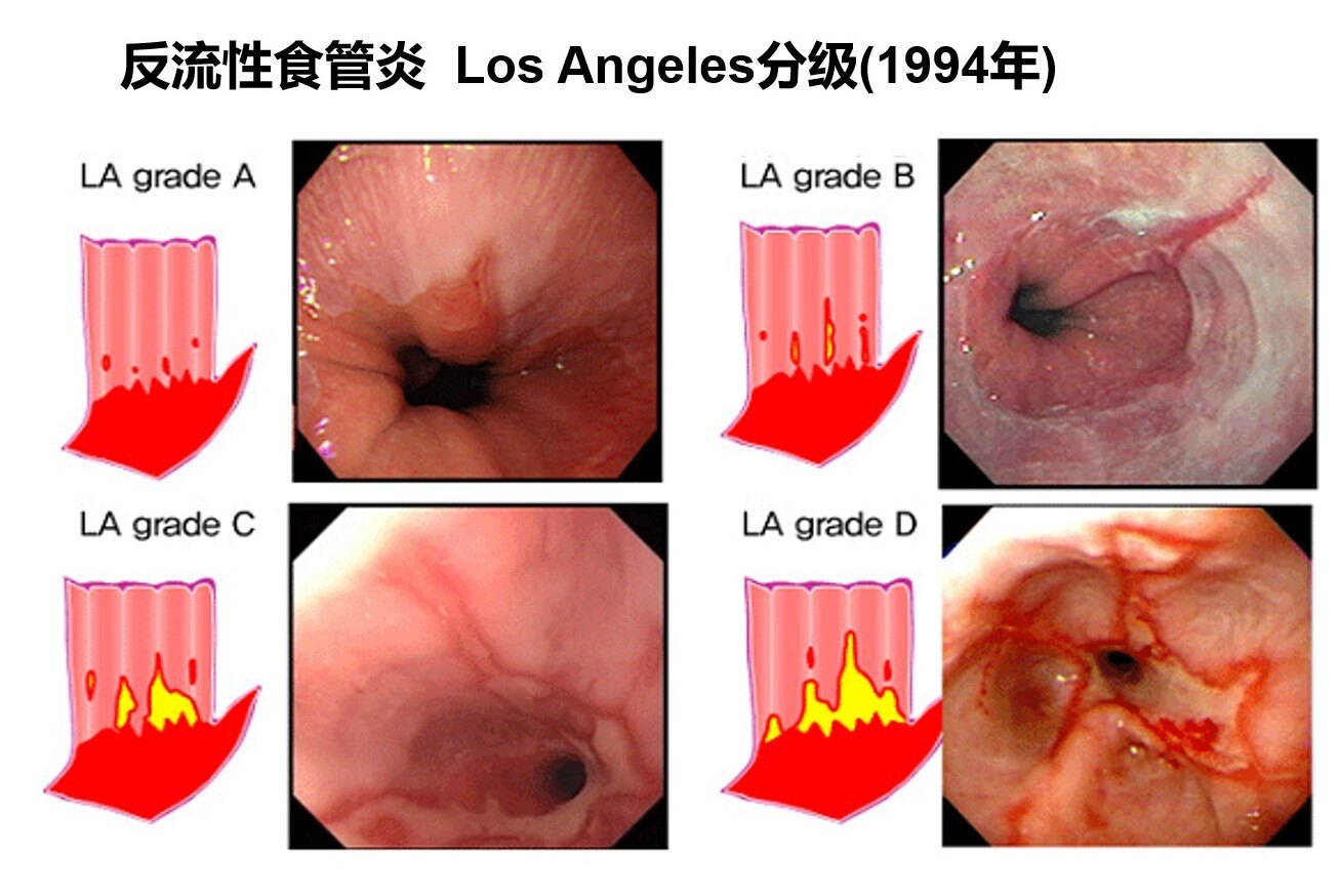 LA-A分级.jpg