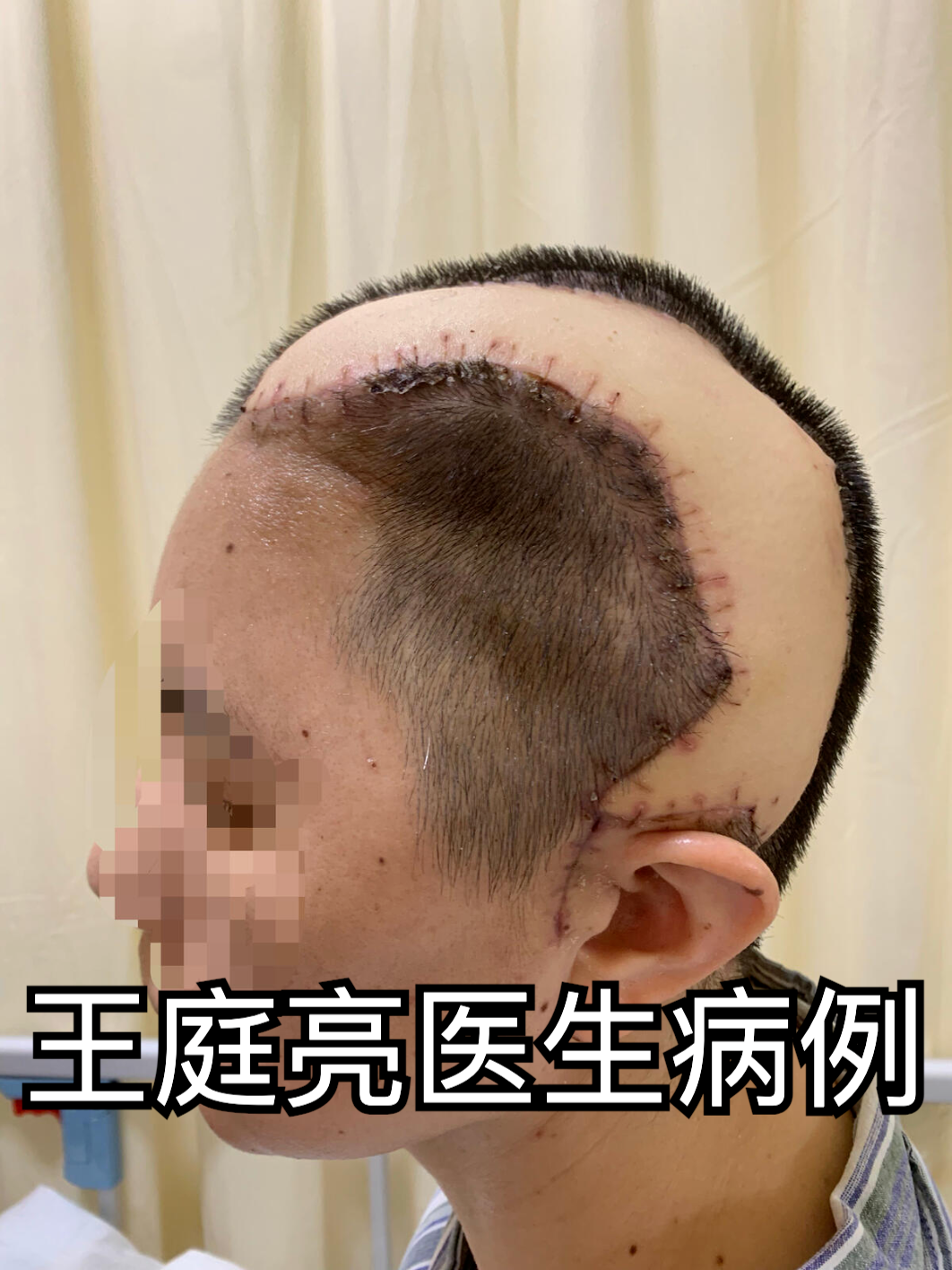 头皮钛网外露怎么办?游离皮瓣显身手