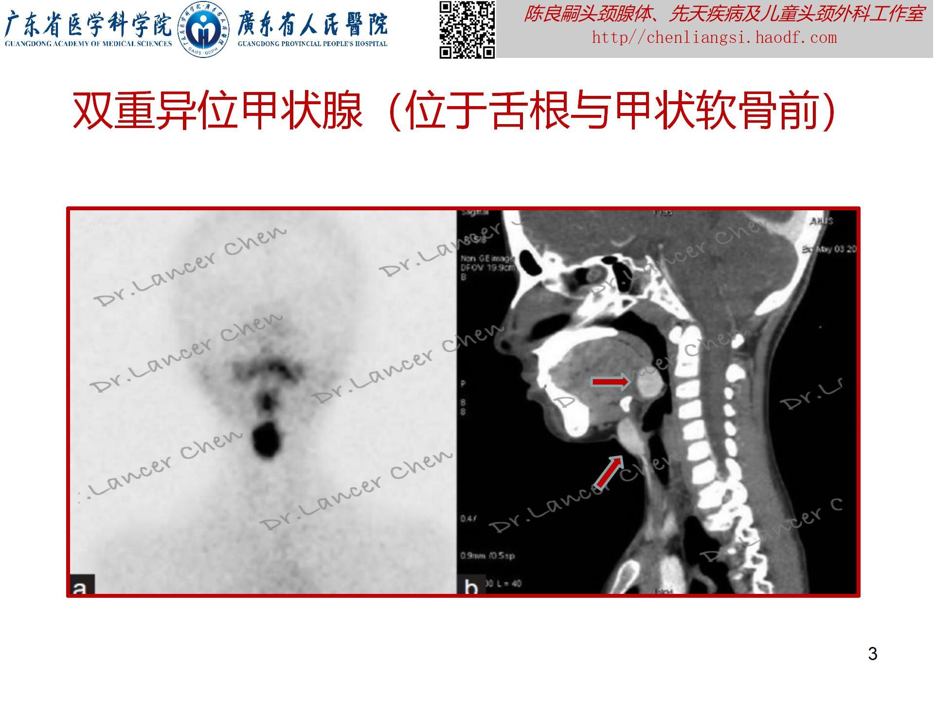 20230723：医学科普——貌似甲状舌管囊肿的罕见先天疾患——异位甲状腺_03.jpg