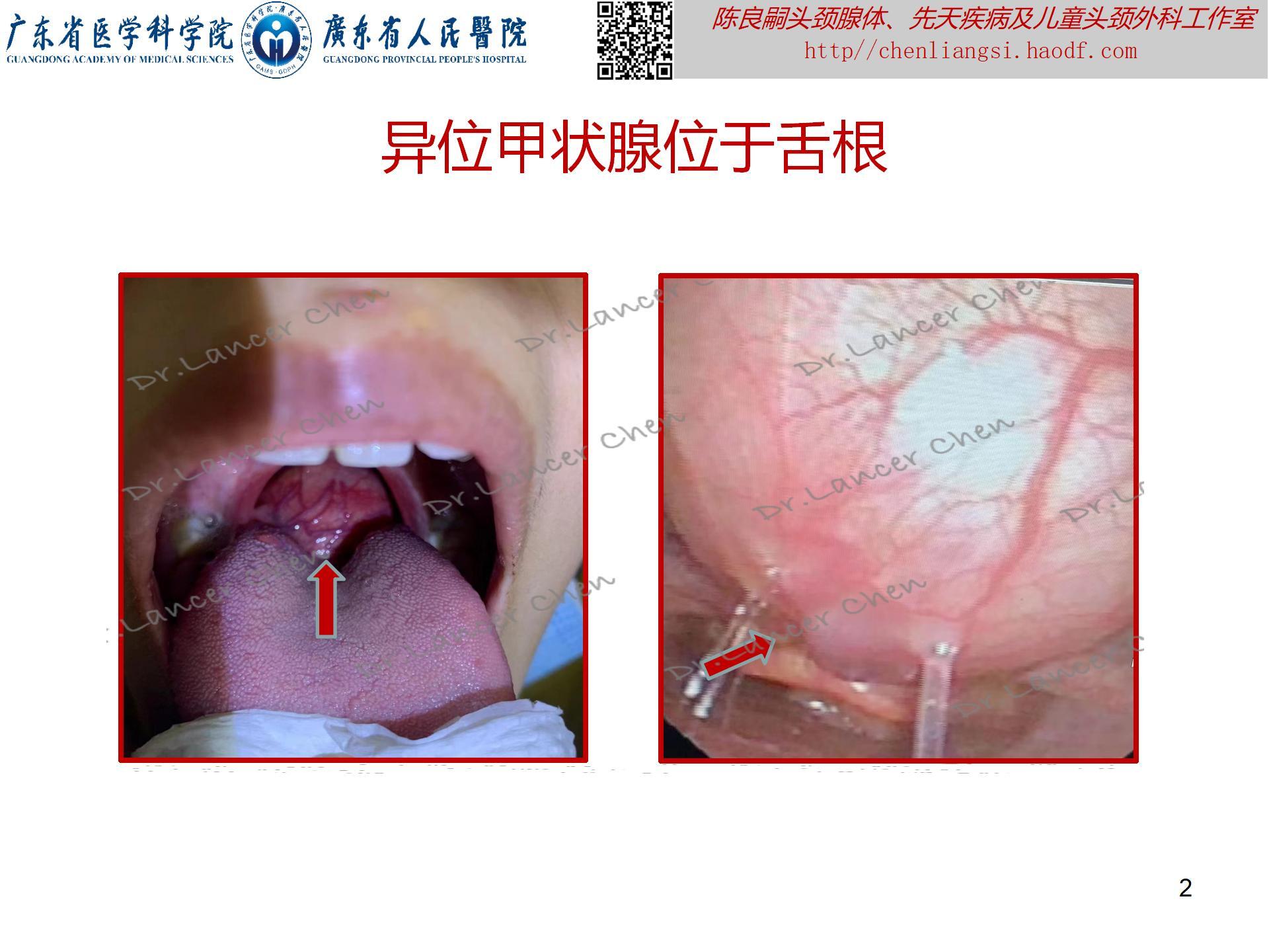 20230723：医学科普——貌似甲状舌管囊肿的罕见先天疾患——异位甲状腺_02.jpg