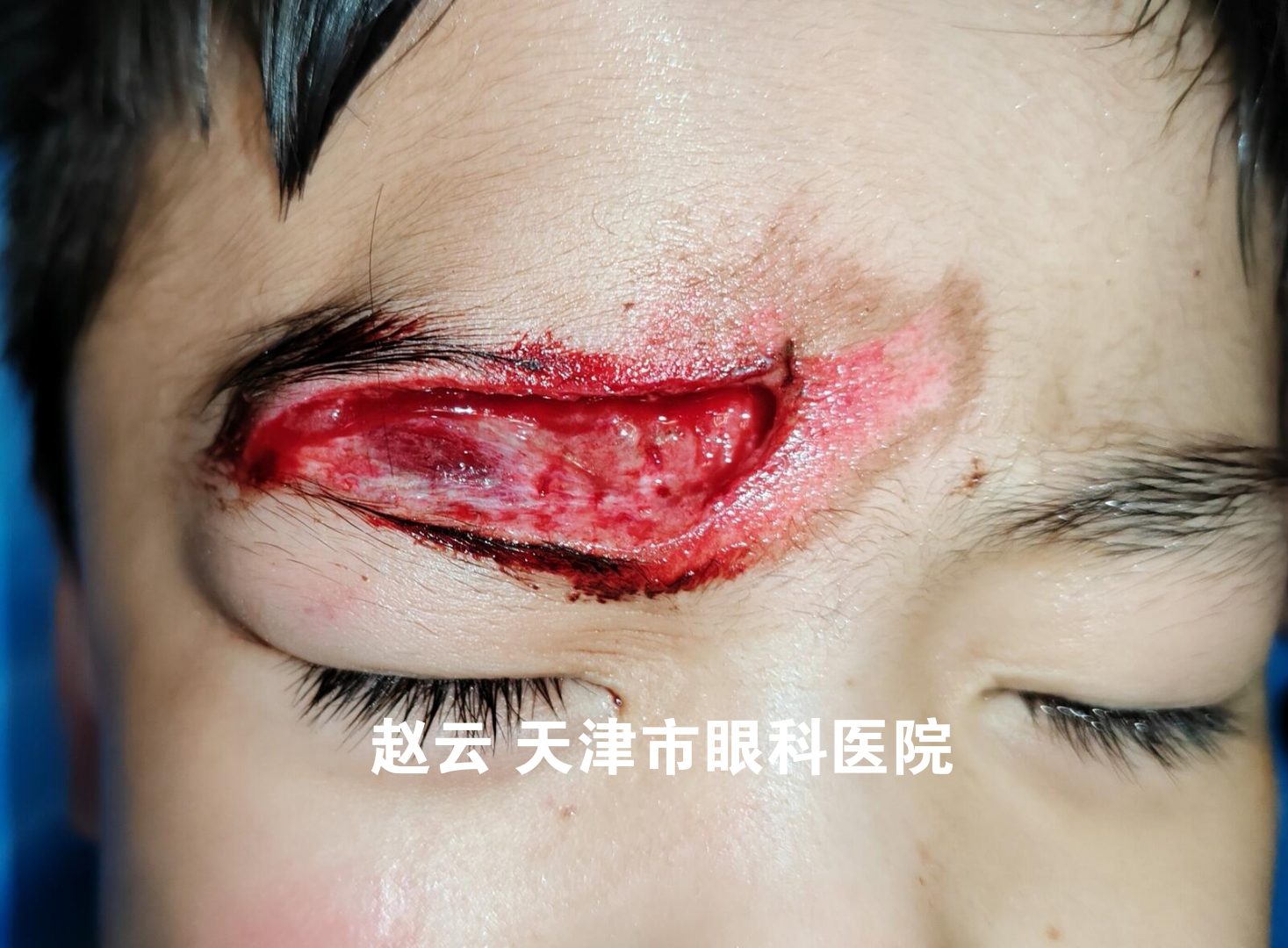 儿童眼睑裂伤急诊缝合