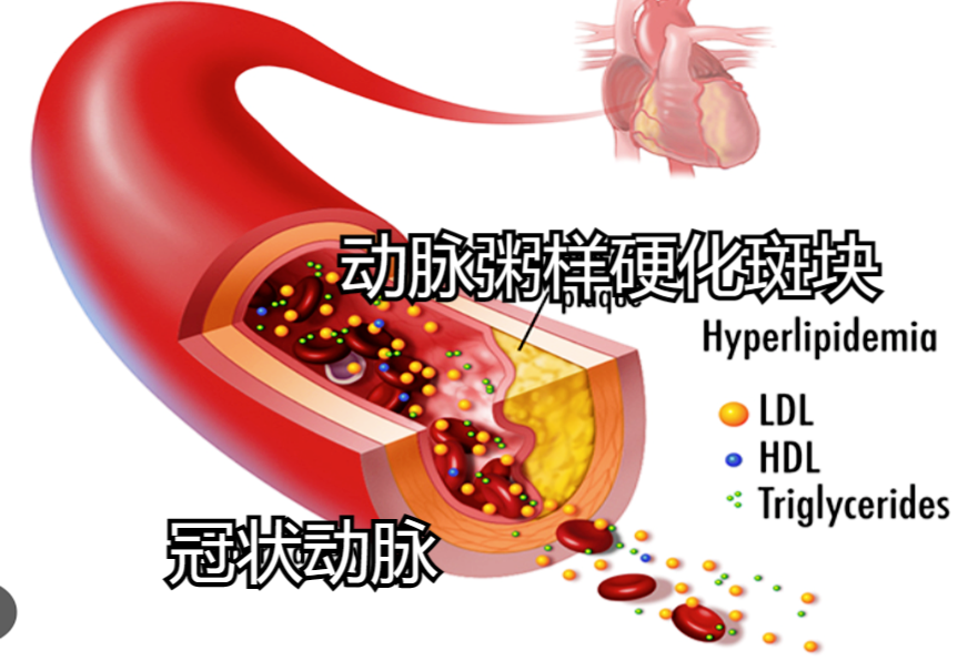 冠心病示意图1.png