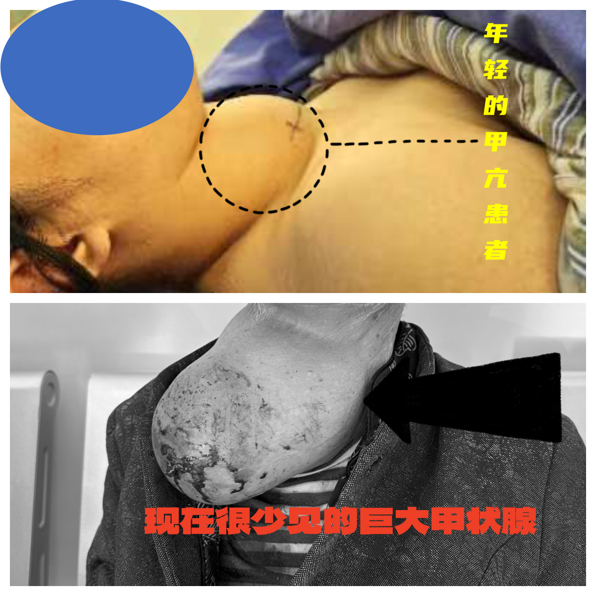 甲状腺肿大图片.png