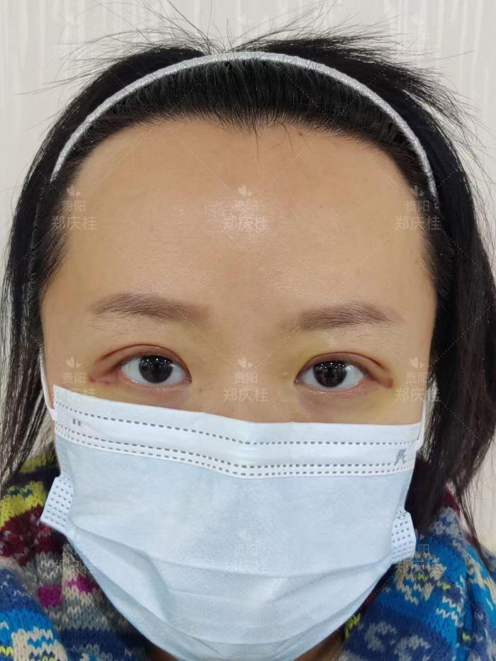 遵义医科大学附属通用医疗300医院医学美容科郑庆桂主任真实案例韩式三点术后5天