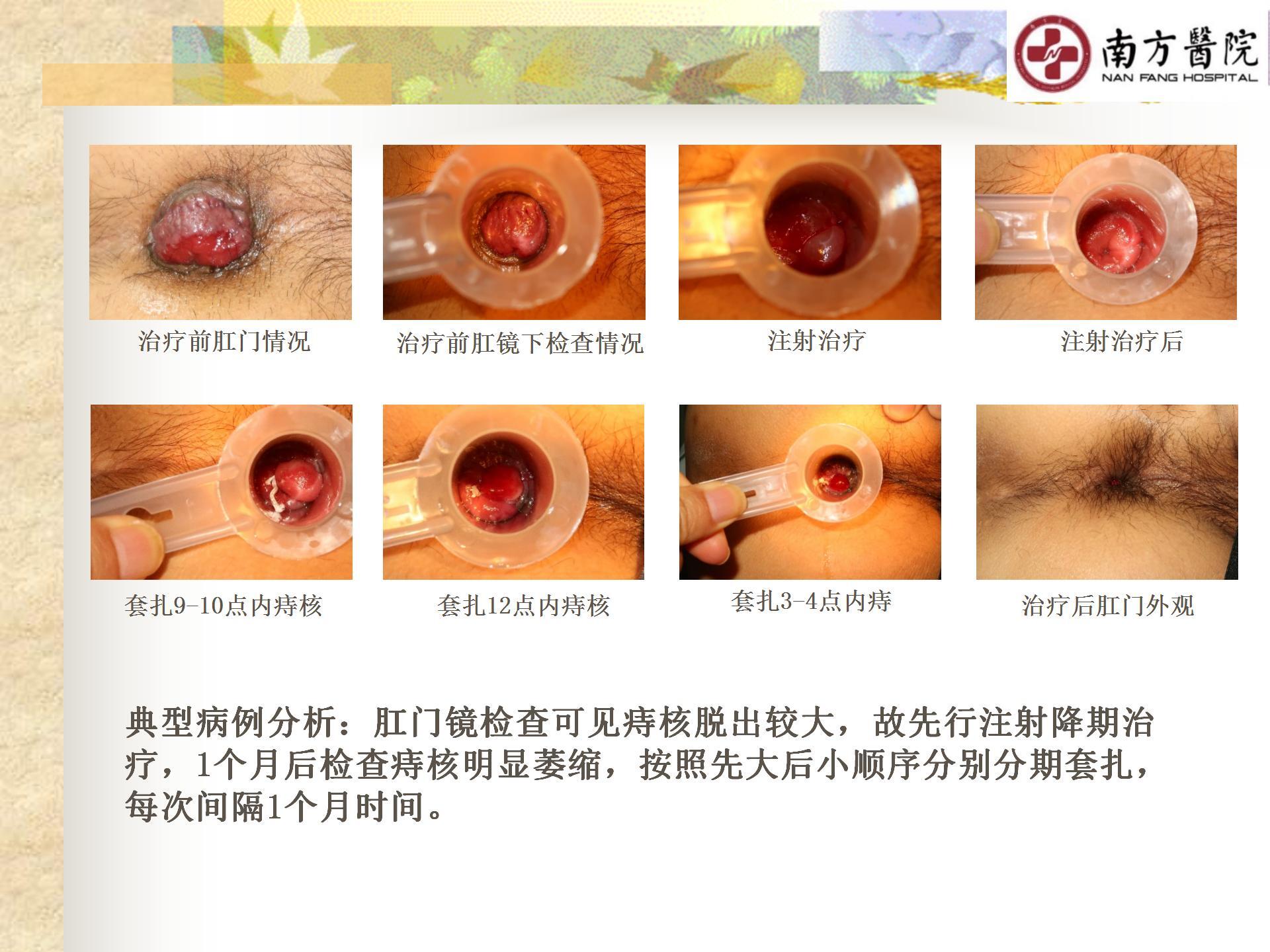 痔的精准化规范化微创化治疗之痔脱出1_13.jpg