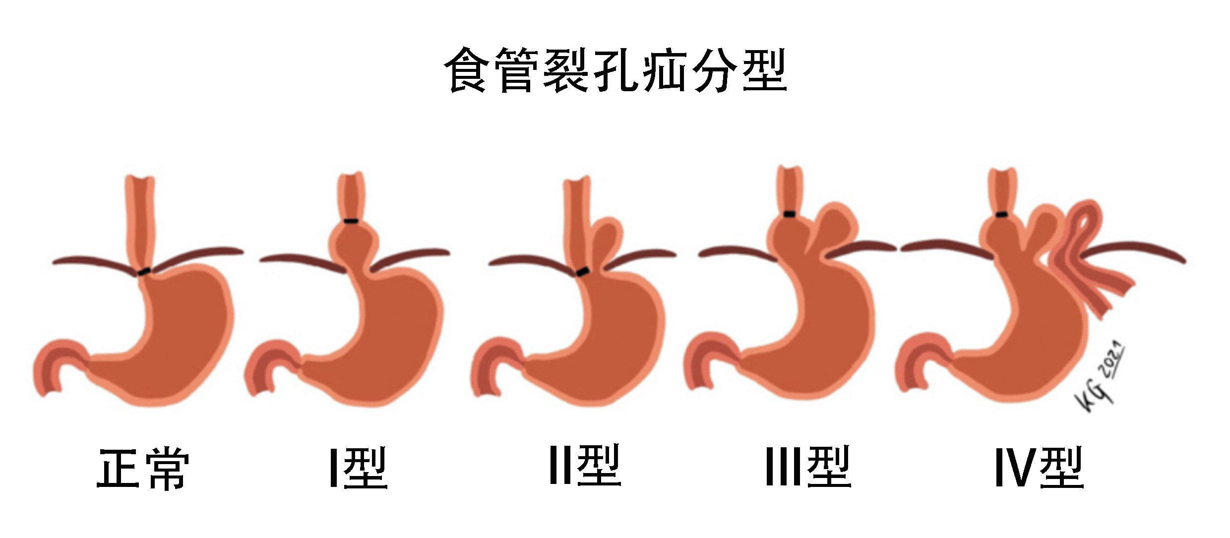 食管裂孔疝分型.jpg