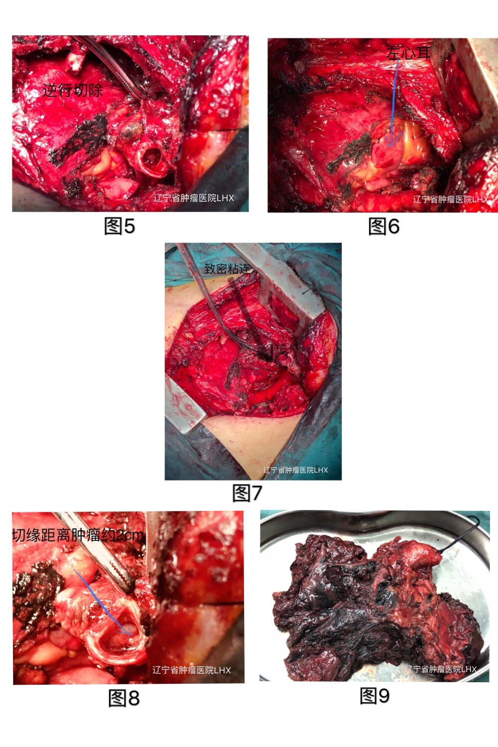 高難度的高齡肺癌二次手術