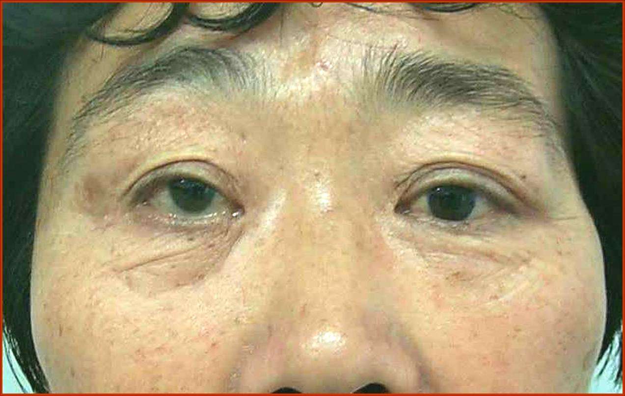 甲状腺眼病手术效果照片 - 好大夫在线