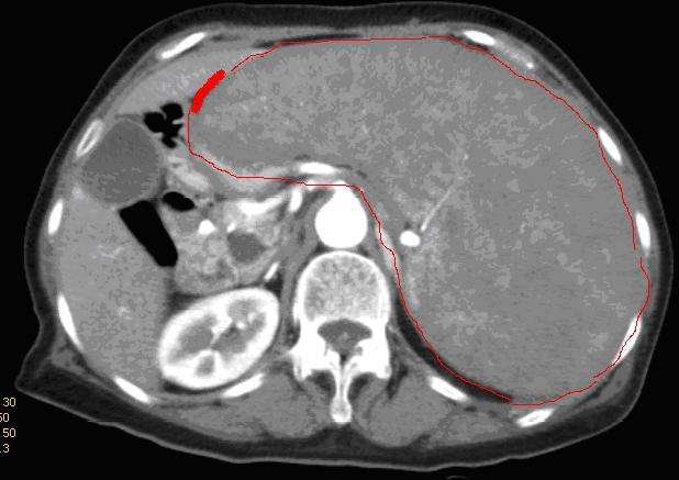 以脾肿大为特点的疾病的手术治疗