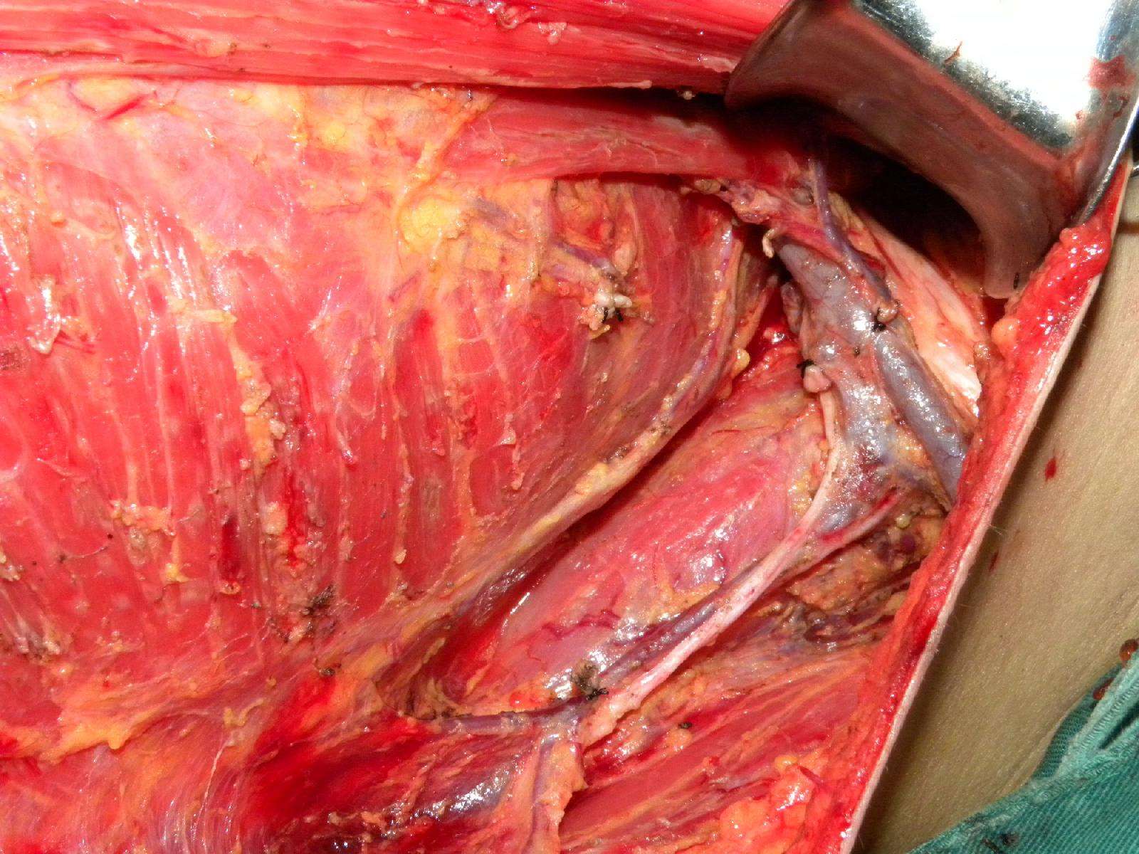 体会包丁解牛的感觉——附最近开的乳腺癌改良根治术照片 - 好大夫