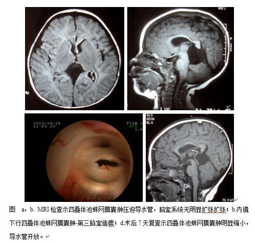 兒童四疊體池蛛網膜囊腫的早期微創治療1例