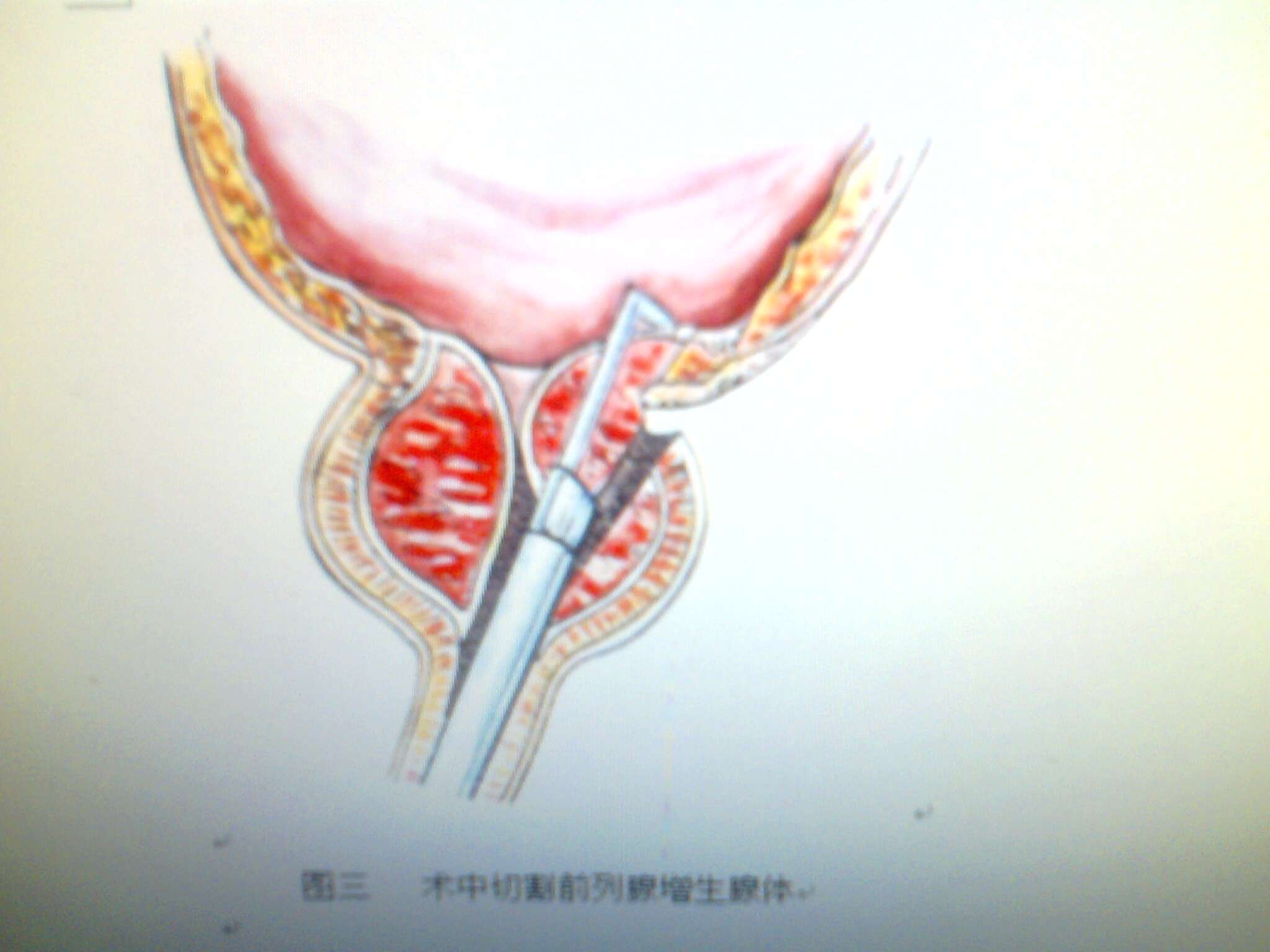 前列腺增生手术示意图图片