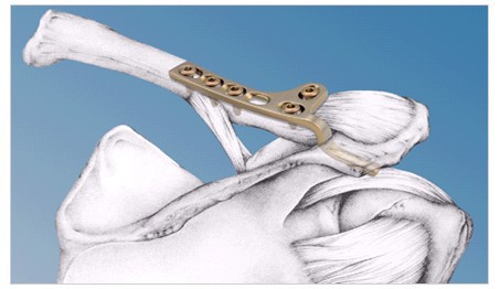 0 锁骨钩钢板固定治疗Ⅲ度肩锁关节脱位 