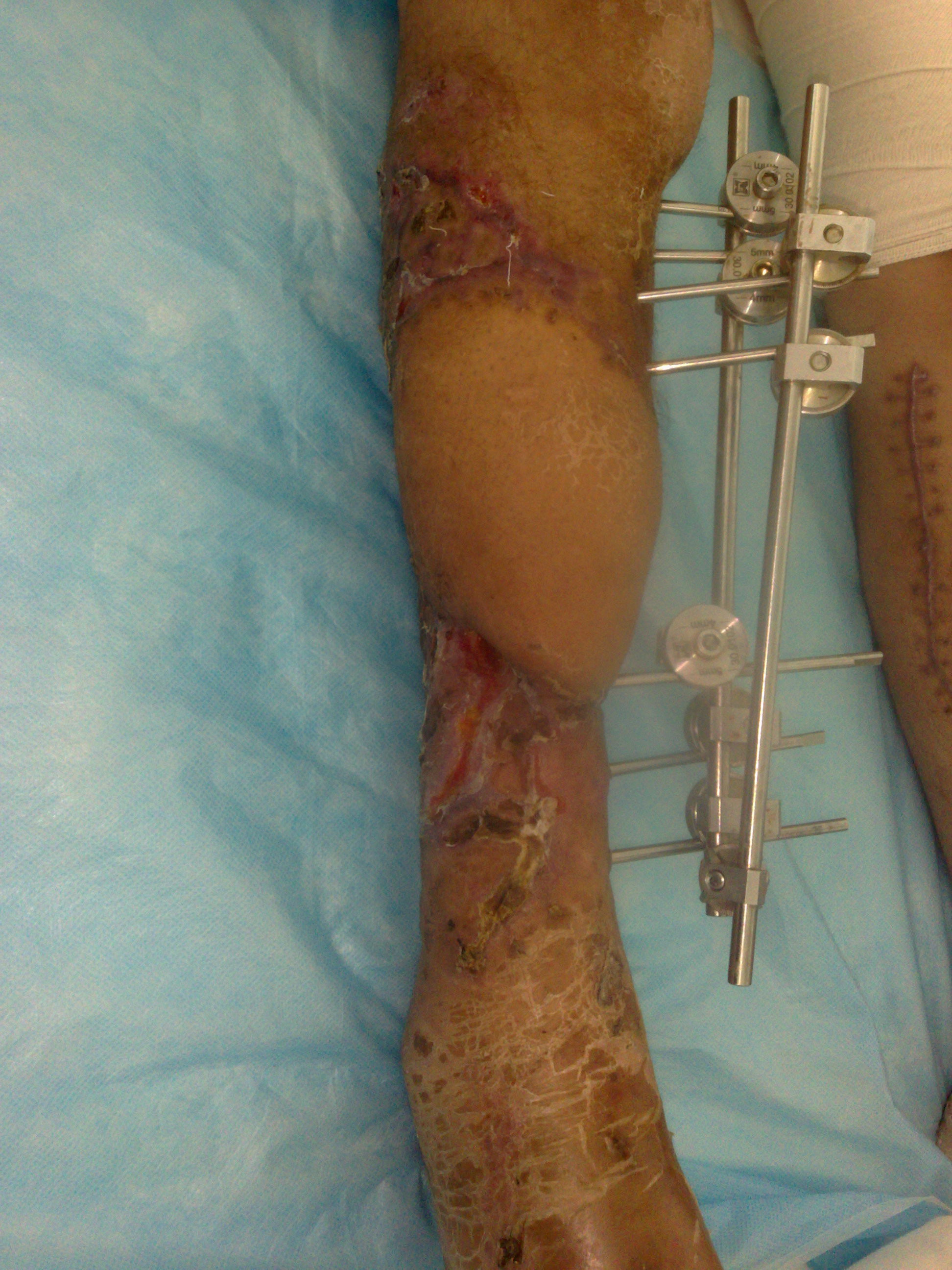 应用显微外科技术修复严重毁损,频临截肢的肢体 - 好大夫在线