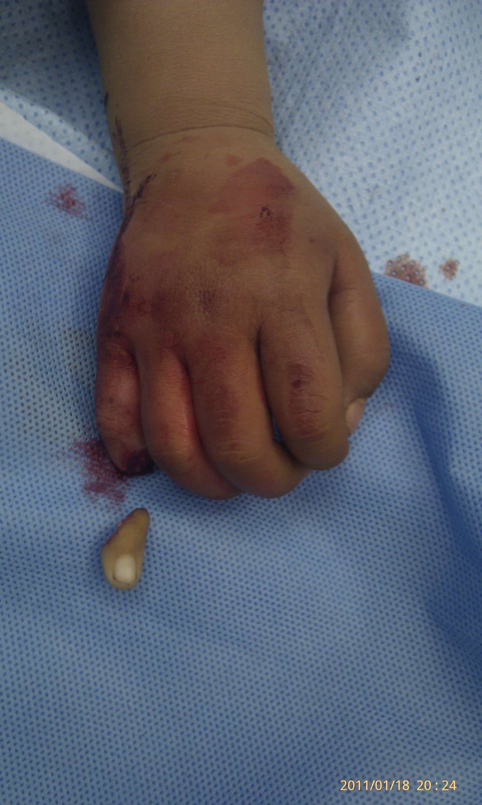 上图分别为术后一月去除克氏针,手术前后及离断手指与1角硬币大小比较