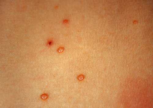 传染性软疣_传染性软疣_疾病介绍_介绍 - 好大夫在线