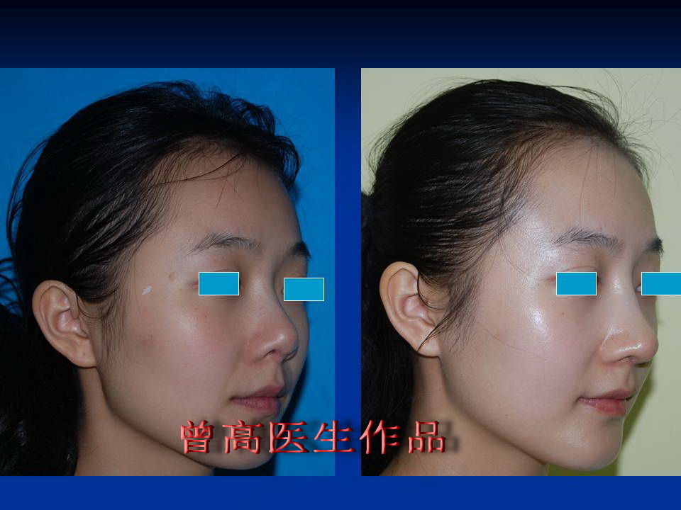 延长鼻尖鼻头缩小术前术后照片