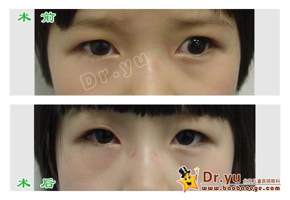 间歇性外斜术前术后2