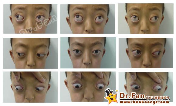 1, 麻痹性斜视,有代偿头位,头向左肩倾斜,左眼下斜肌亢进,左眼上斜肌