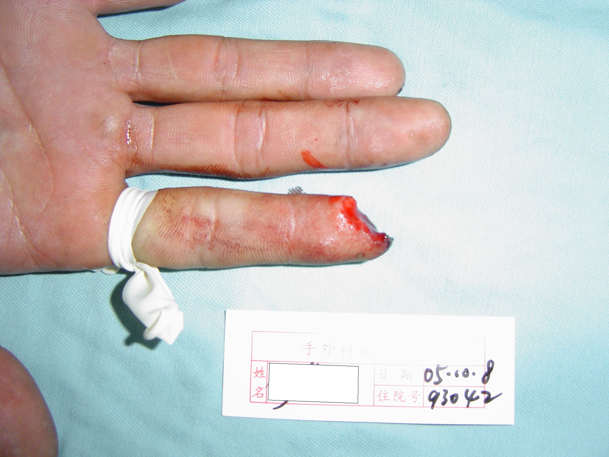 手指缺失伤残图图片