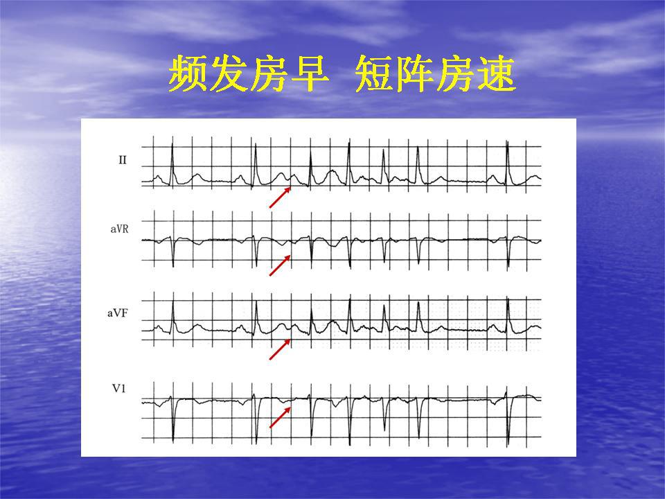 房性早搏房速的治疗