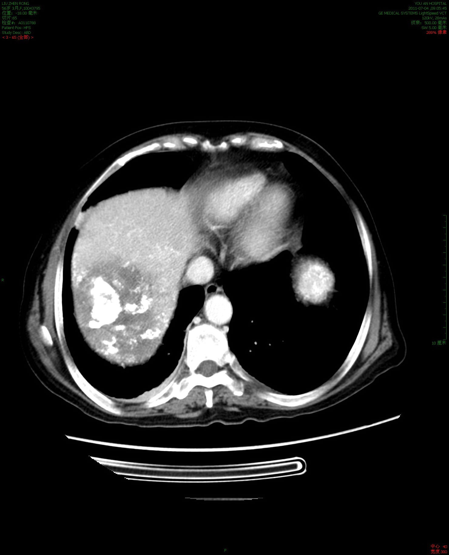 消融肿瘤40%-50%微创治疗前增强ct56岁的肝癌晚期患者,女性